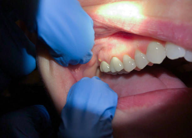 Best Broken or Chipped Tooth Repair in Flossmoor, IL